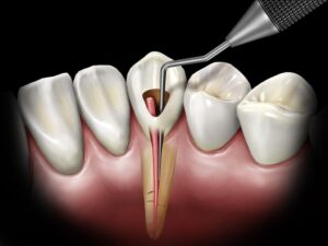 Bayrampaşa Diş Endodonti Fiyatları